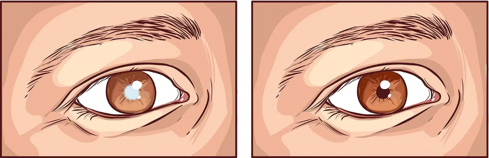 How Long Does Cataract Surgery Take?