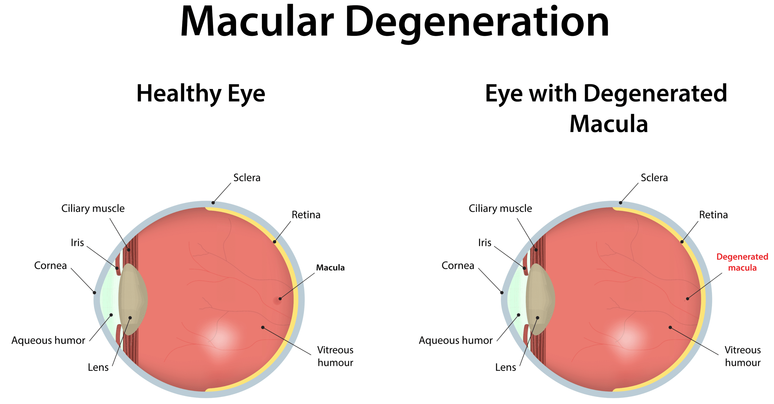 Illustration of a healthy eye next to one of a degenerated macula in AMD