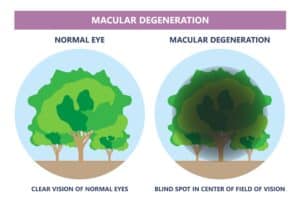 Image showing a tree seen through normal vision next to a blotted-out tree seen through an eye with advanced AMD